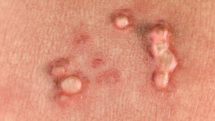 hpv-warts-722x406.jpg