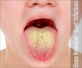 yeast-infections.jpg