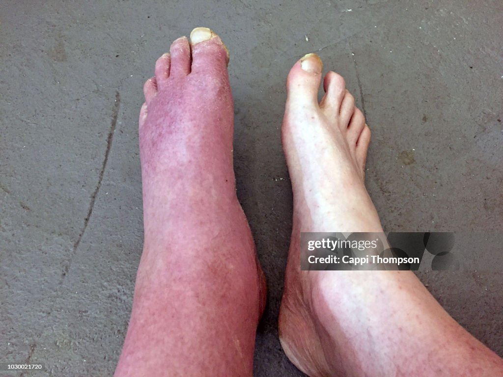 a-severely-swollen-foot-in-a-man-from-a-head-on-car-accident.jpg